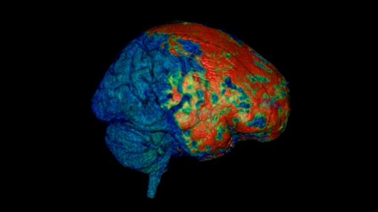 brain_concussion_MRI